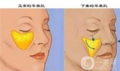 影響自體脂肪填充淚溝維持時間的因素有哪些？