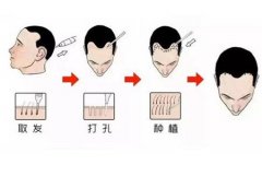 植發(fā)的脫落期會(huì)影響植發(fā)的效果嗎