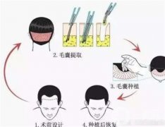 植發(fā)需要多長(zhǎng)時(shí)間才能看到效果？