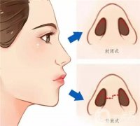 鼻小柱延長(zhǎng)手術(shù)失敗后如何進(jìn)行修復(fù)呢？