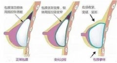 假體隆胸怎么樣，術(shù)后怎么護理