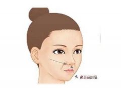 矯正鷹鉤鼻手術(shù)的效果如何呢？