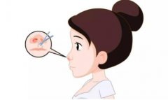 鼻孔縮小手術(shù)是否安全？是否有風(fēng)險(xiǎn)
