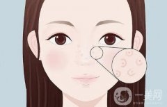填充蘋果肌的作用有哪些？