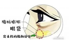 眼袋去除手術(shù)失敗怎么辦？