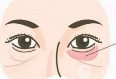 眼袋手術(shù)是否存在風(fēng)險(xiǎn)，具體有哪些方式呢？