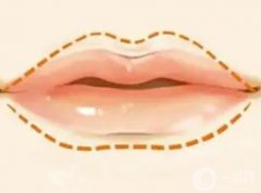 有哪些因素影響玻尿酸豐唇珠的價(jià)格