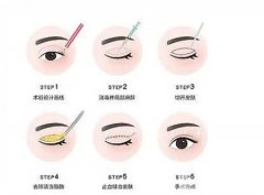 做雙眼皮手術(shù)具體有哪些好處呢？