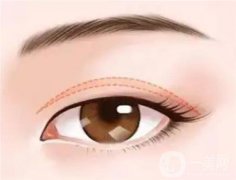 開眼角手術(shù)的適合人群及效果