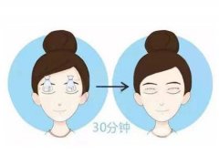 埋線雙眼皮手術適合哪些人群？
