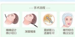 面部能否進行水動力吸脂？安全性如何？