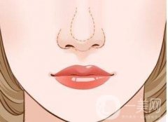 哪些因素與鼻部矯正手術(shù)的費用相關(guān)？