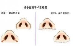 哪些情況下適合進行鼻孔縮小術