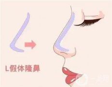 哪些因素影響著墊鼻梁手術(shù)的費用呢？
