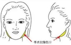 切骨瘦臉手術(shù)可能出現(xiàn)哪些并發(fā)癥？