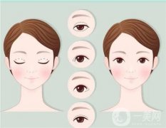 全切雙眼皮術(shù)后的飲食注意事項