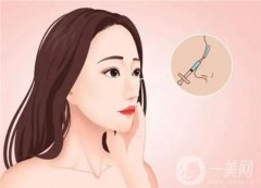 鼻綜合有后遺癥嗎？要注意哪些事項(xiàng)