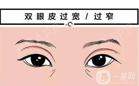 韓式*開眼角價格 韓式*開眼角多少錢？