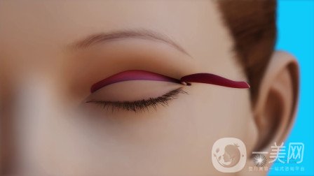 *開眼角貴嗎？價格是多少？